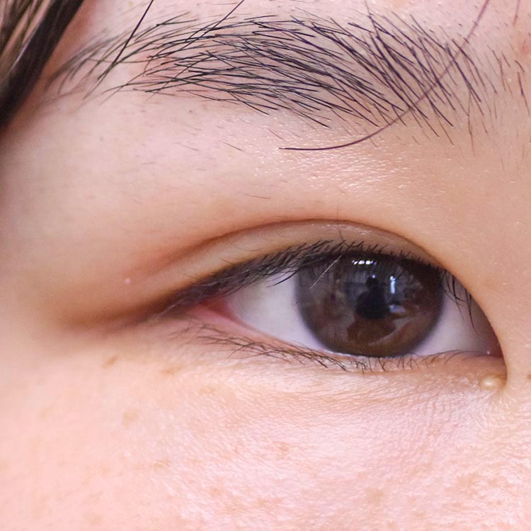 手術後　脂肪切除を併用し、自然な二重ラインに