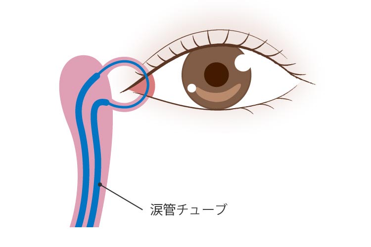 チューブ留置術