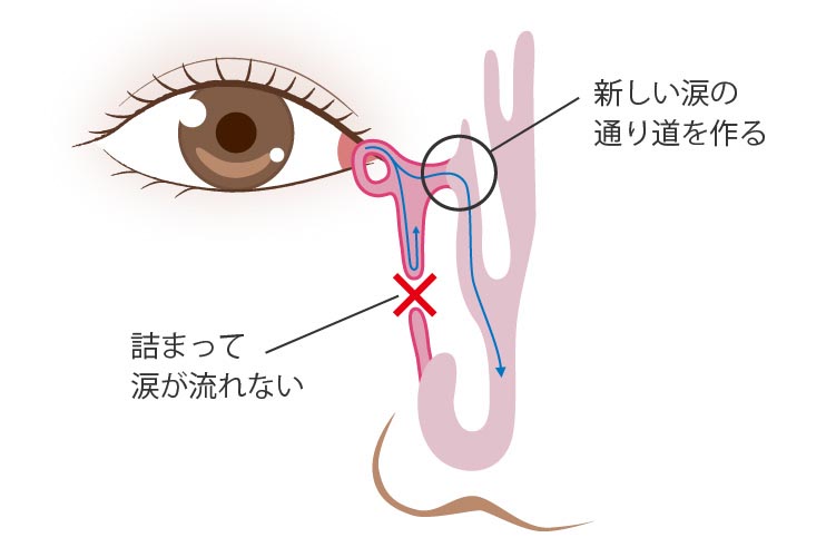 涙嚢鼻腔吻合術